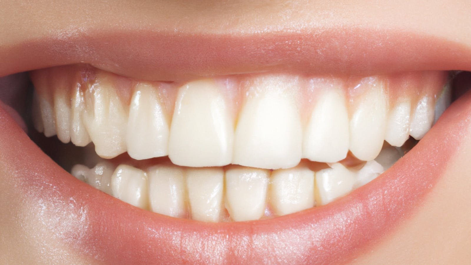 Sbiancamento denti a casa con Diamond Smile: guida 2026 + codice sconto -15%